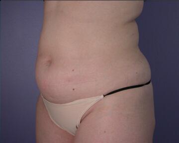 Liposuction Before & After Image