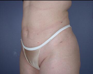 Liposuction Before & After Image