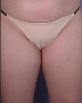 Liposuction Before & After Image