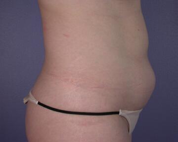 Liposuction Before & After Image