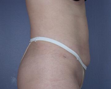 Liposuction Before & After Image