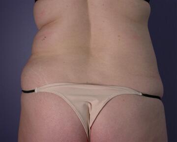 Liposuction Before & After Image