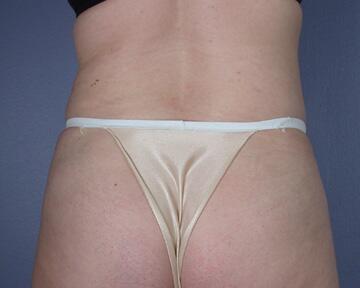 Liposuction Before & After Image