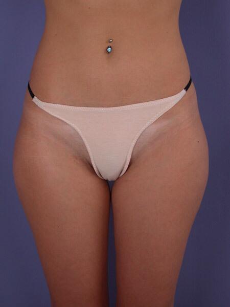 Liposuction Before & After Image