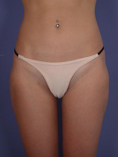 Liposuction Before & After Image