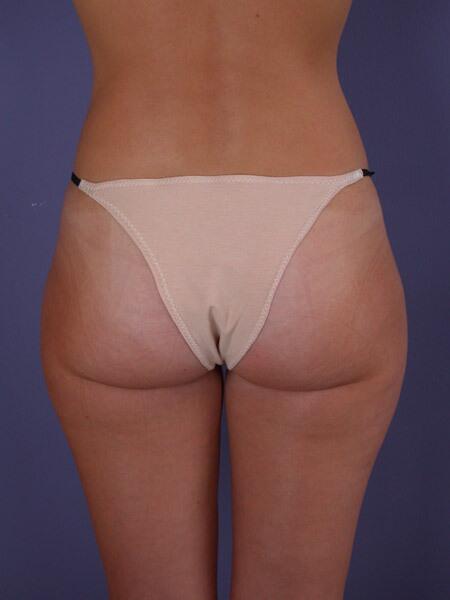 Liposuction Before & After Image