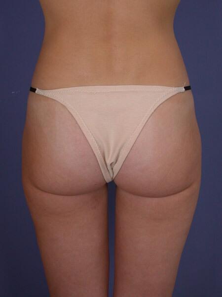 Liposuction Before & After Image