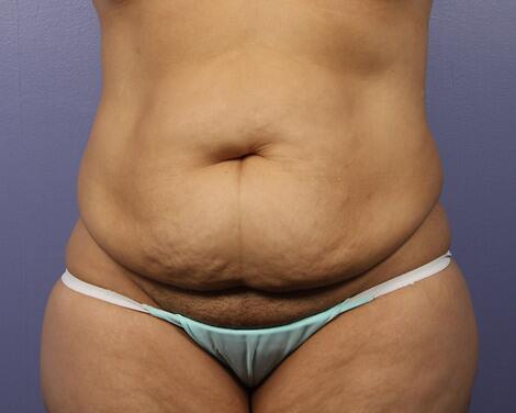 Liposuction Before & After Image