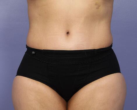 Liposuction Before & After Image