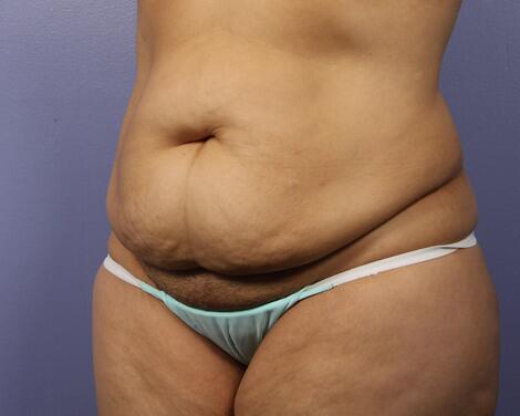 Liposuction Before & After Image