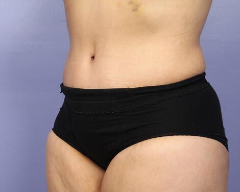 Liposuction Before & After Image