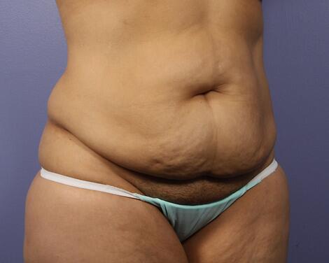 Liposuction Before & After Image