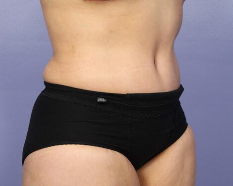 Liposuction Before & After Image