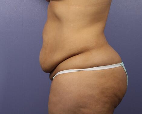 Liposuction Before & After Image