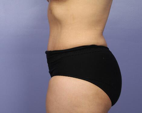 Liposuction Before & After Image