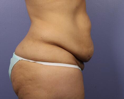 Liposuction Before & After Image