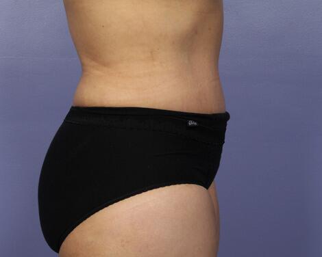 Liposuction Before & After Image