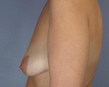 Liposuction Before & After Image