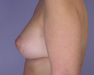 Liposuction Before & After Image