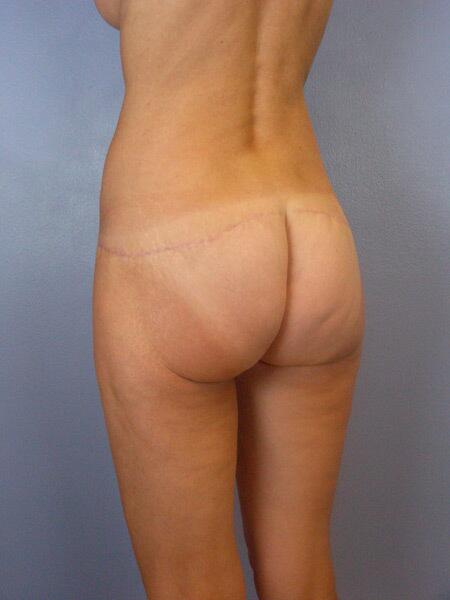 Liposuction Before & After Image