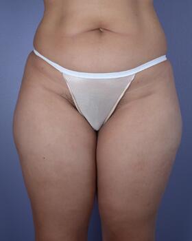 Liposuction Before & After Image