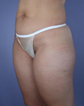 Liposuction Before & After Image