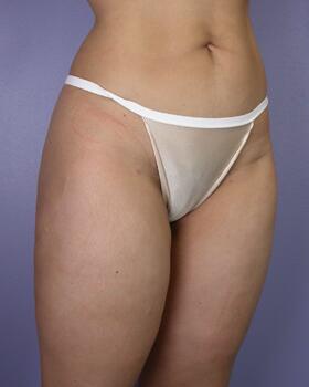 Liposuction Before & After Image