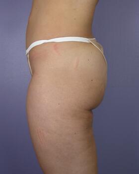 Liposuction Before & After Image