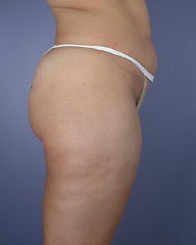 Liposuction Before & After Image