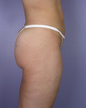 Liposuction Before & After Image