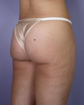 Liposuction Before & After Image