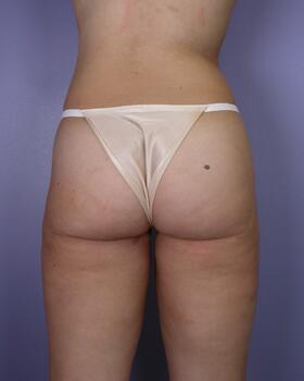 Liposuction Before & After Image