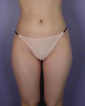 Liposuction Before & After Image