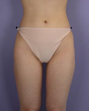 Liposuction Before & After Image