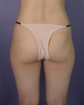 Liposuction Before & After Image