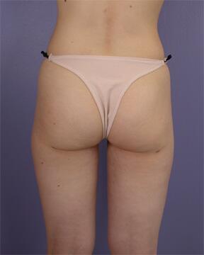 Liposuction Before & After Image