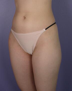 Liposuction Before & After Image