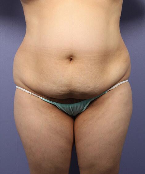 Liposuction Before & After Image