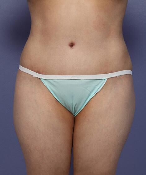 Liposuction Before & After Image