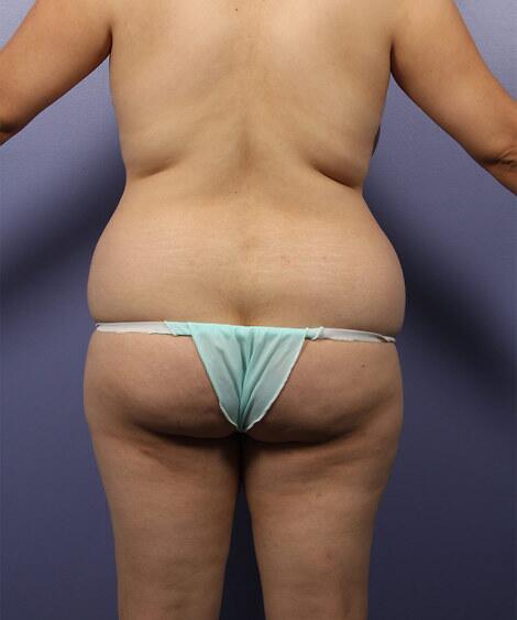 Liposuction Before & After Image