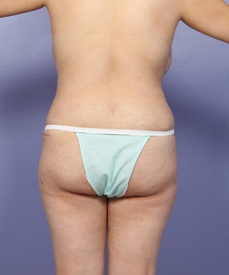 Liposuction Before & After Image