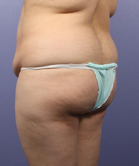 Liposuction Before & After Image