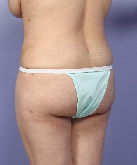 Liposuction Before & After Image