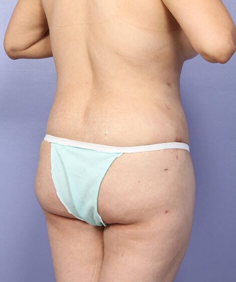 Liposuction Before & After Image