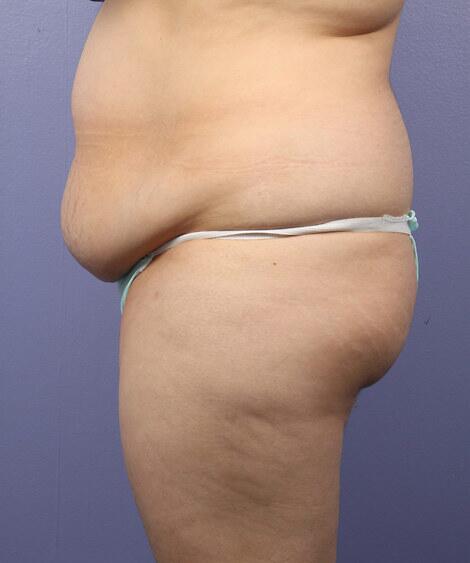 Liposuction Before & After Image