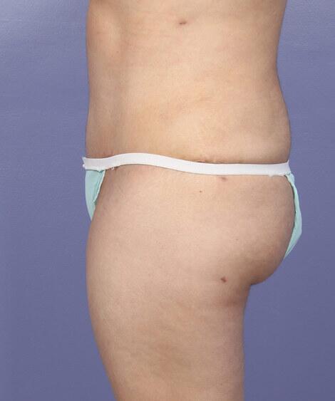 Liposuction Before & After Image