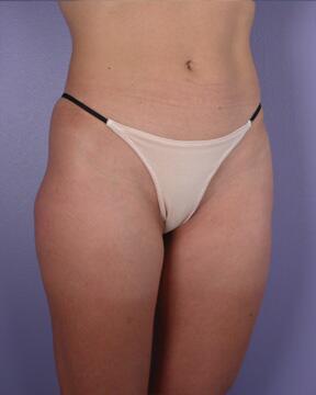 Liposuction Before & After Image