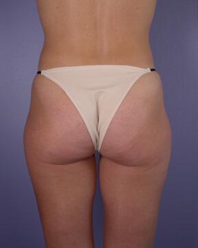 Liposuction Before & After Image