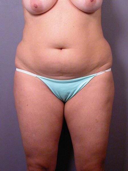 Liposuction Before & After Image