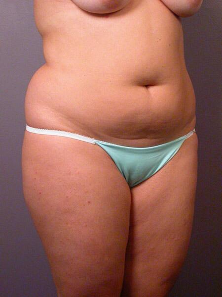 Liposuction Before & After Image